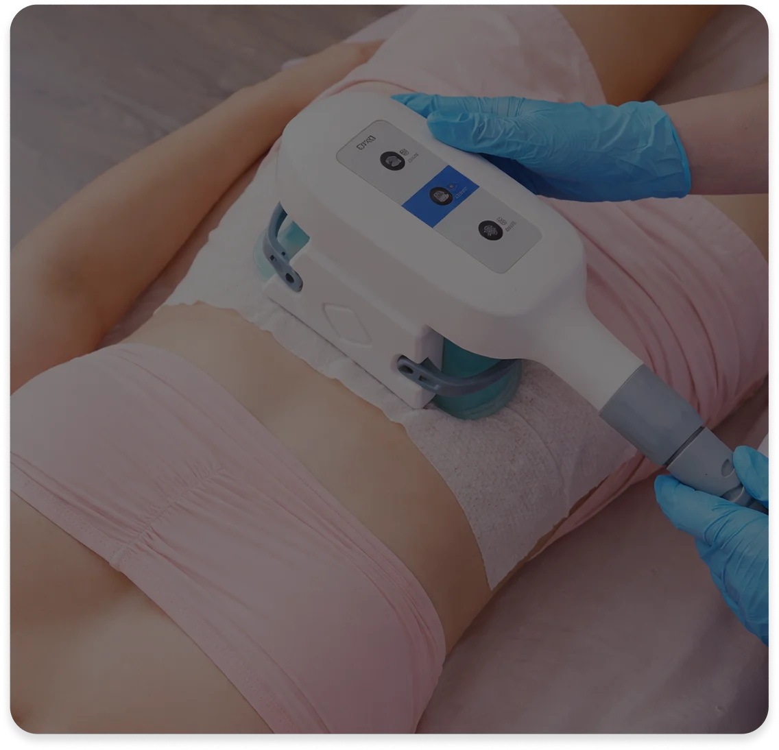 Criolipólisis de placa